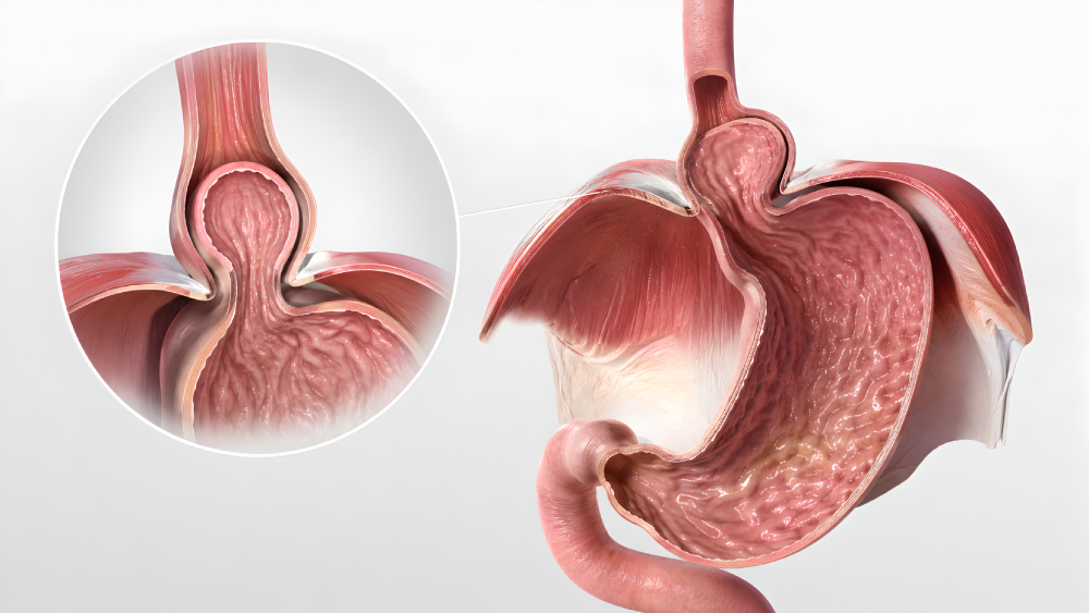 hiatal-hernia