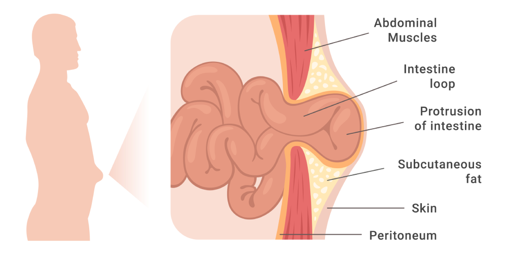 umbilical-hernia
