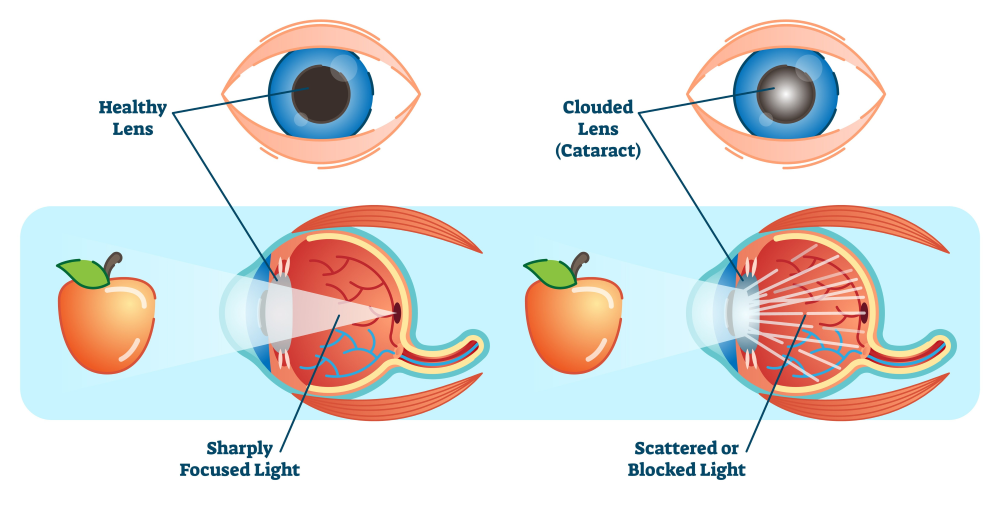 cataract
