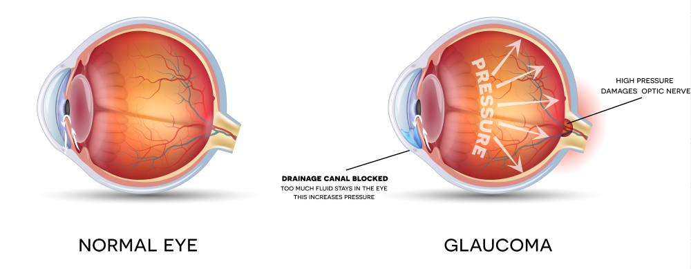 glaucoma