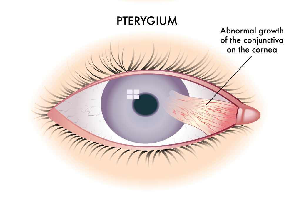 pterygium