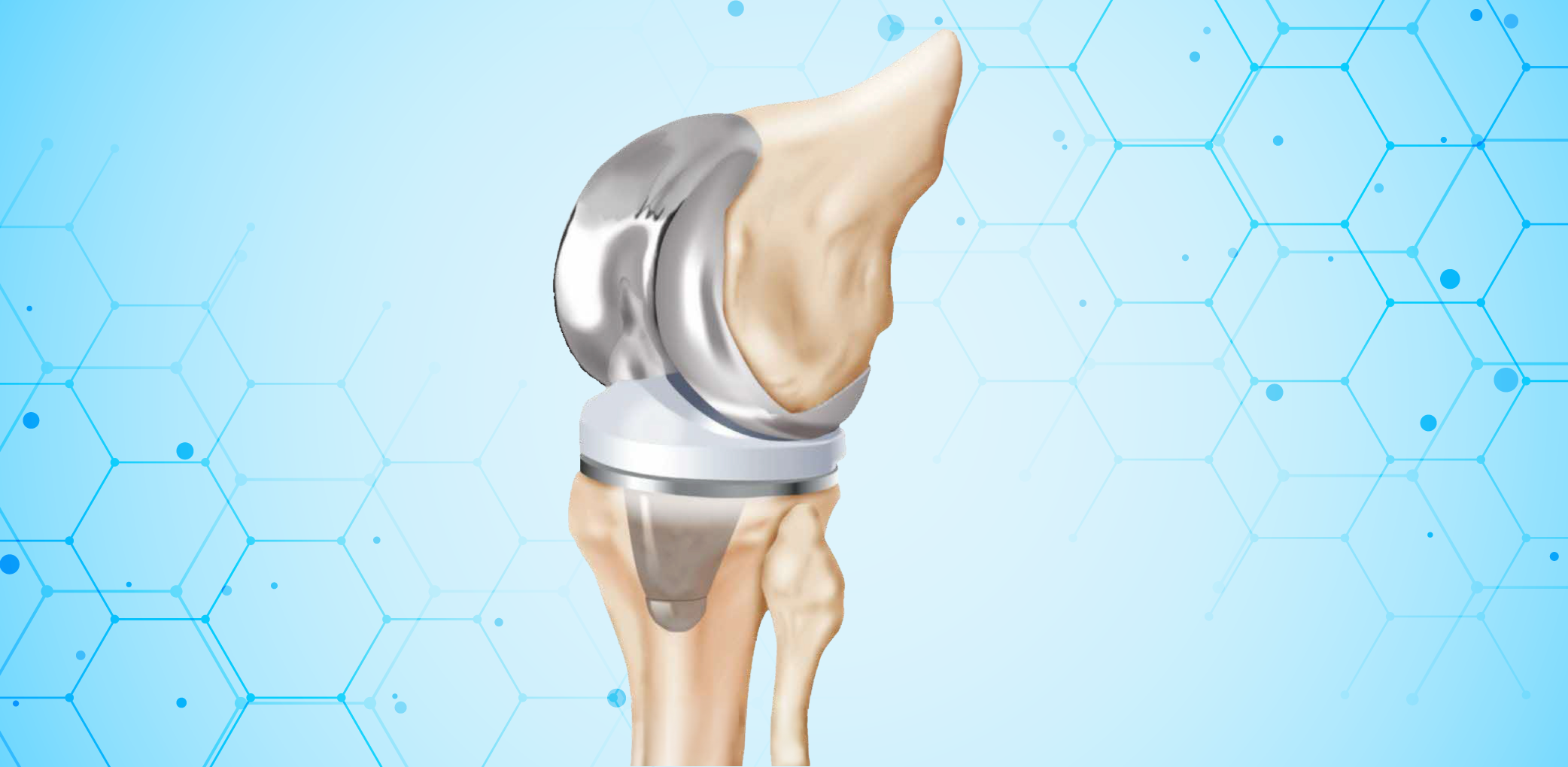 total-knee-replacement-surgery-singapore